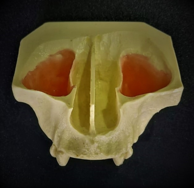 Sinus Lift Model