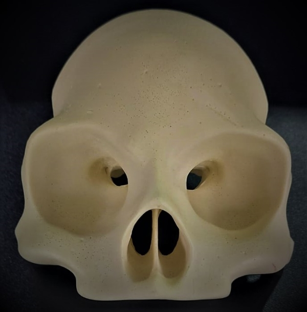 Zygoma Implant Model