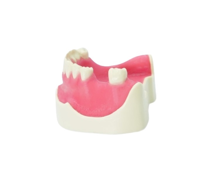 Standard Implant Model